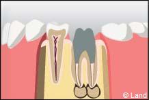 traitement radiculaire